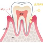 大船　歯医者　歯周病